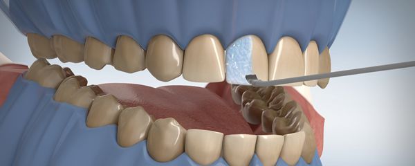 Bleaching in Moers für weißere Zähne