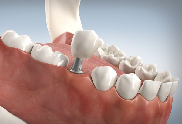 Feste Zähne mit Zahnimplantaten in Moers